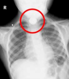 　ボタン電池を誤飲した子どものＸ線検査画像（国民生活センターの発表資料より）