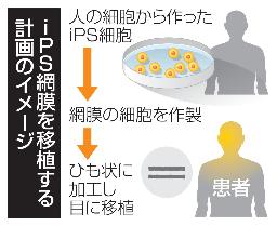 　ｉＰＳ網膜を移植する計画のイメージ